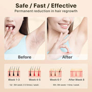 Laser Hair Removal
