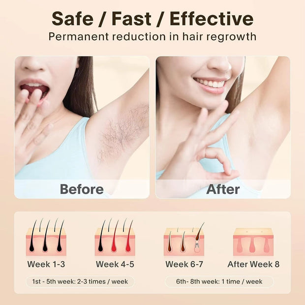 Laser Hair Removal